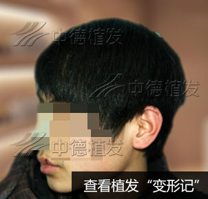 8岁小林疤痕植发收获快乐童年