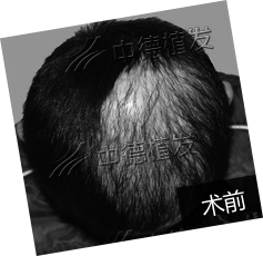 8岁小林疤痕植发收获快乐童年