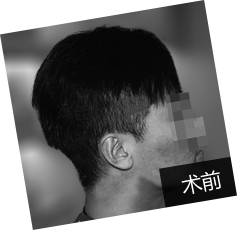 30岁张先生鬓角移植得偿所愿