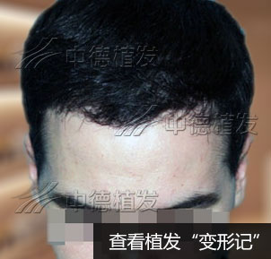 美国大男孩Make中德植发变更帅