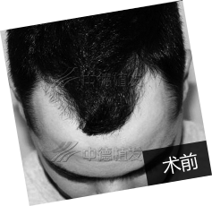 美国大男孩Make中德植发变更帅