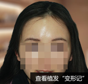 甘女士真眉移植收获立体好眉毛