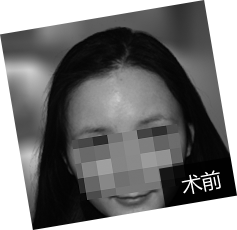 甘女士真眉移植收获立体好眉毛