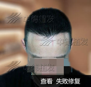 宋涛：两次植发失败，中德成功修复