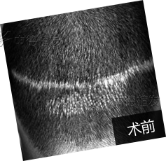 宋涛：两次植发失败，中德成功修复