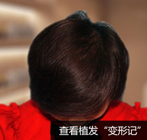 35岁黄女士头发加密变漂亮