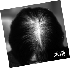 35岁黄女士头发加密变漂亮