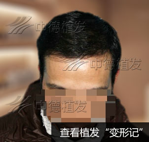 25岁曹先生植发年轻10岁