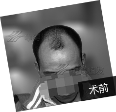 25岁曹先生植发年轻10岁