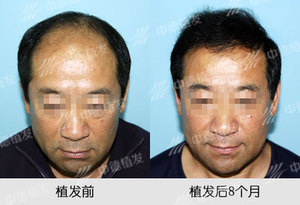 脱发,脱发治疗