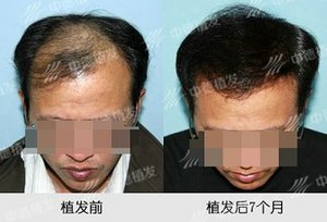 脱发,植发效果