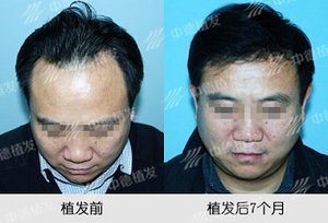 脱发,脱发怎么办
