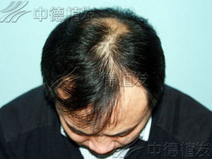 脱发,脱发怎么办