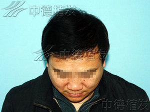脱发,脱发怎么办