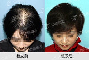 脱发,头发加密