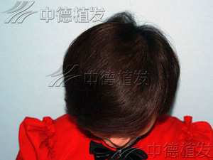脱发,头发加密