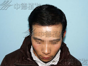 植发,植发找回自信