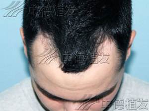 脱发,中德植发,