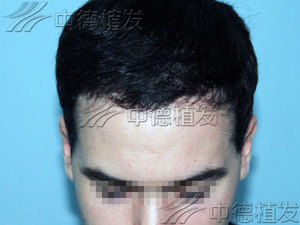 脱发,中德植发,