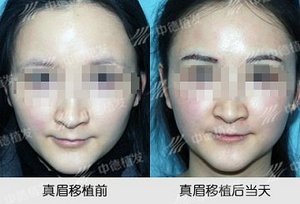 眉毛移植,眉毛种植