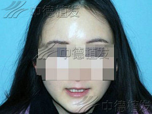眉毛移植,眉毛种植