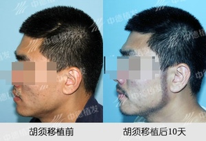 络腮胡种植,