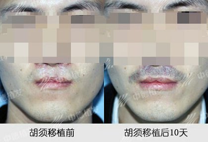 胡须移植,