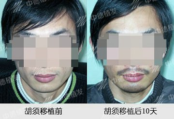 胡须移植,胡须种植