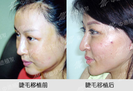 睫毛,睫毛移植