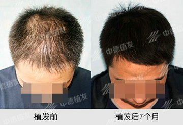 脱发,头发加密,