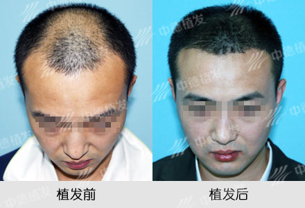 植发,头发加密