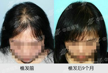 植发 ,头发加密