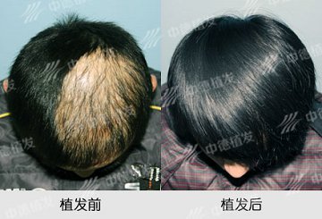 儿童植发,疤痕植发