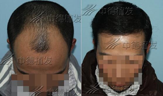 脱发,脱发治疗,头发种植