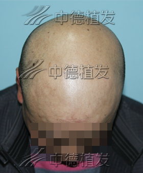 秃顶,头发种植