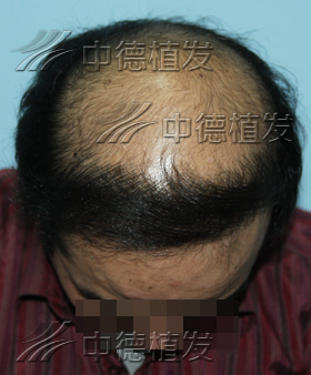 秃顶,头发种植