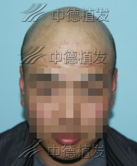 秃顶,头发种植