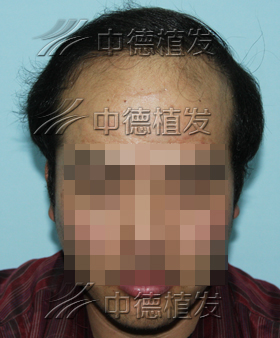 秃顶,头发种植