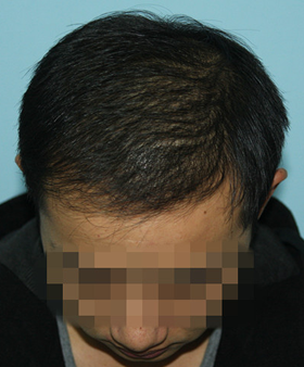 头发种植,脱发
