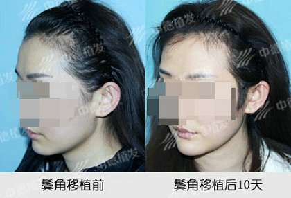 鬓角种植,