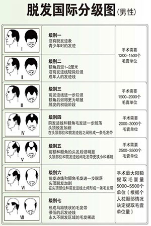 发际线种植,发际线调整