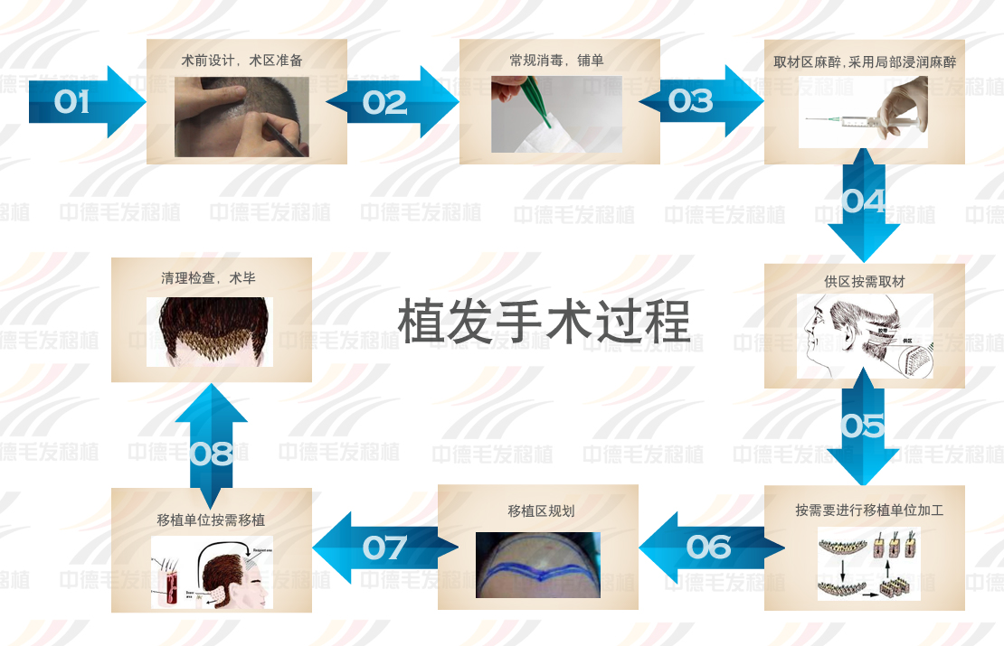 头发种植,脱发