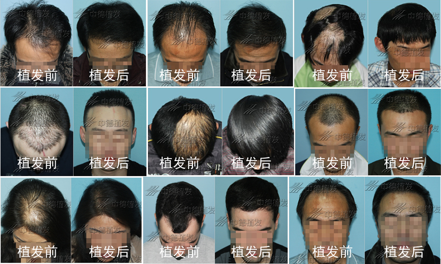 头发种植,脱发