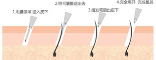 头发种植,头发怎么种植