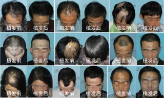 脱发,脱发怎么办