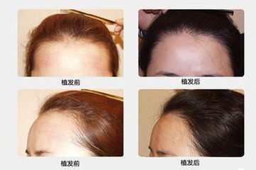 调整发际线,发际线价格