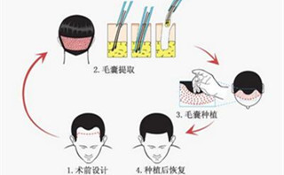 头发加密,脱发