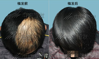 头发加密,脱发
