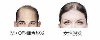 头发,头发稀少怎么办
