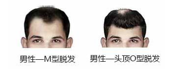 头发,头发稀少怎么办